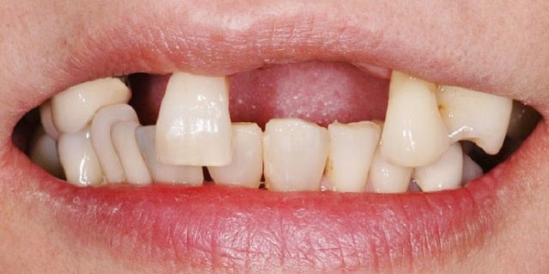 Mơ thấy gãy răng: Giải mã ý nghĩa và con số may mắn cùng CF68